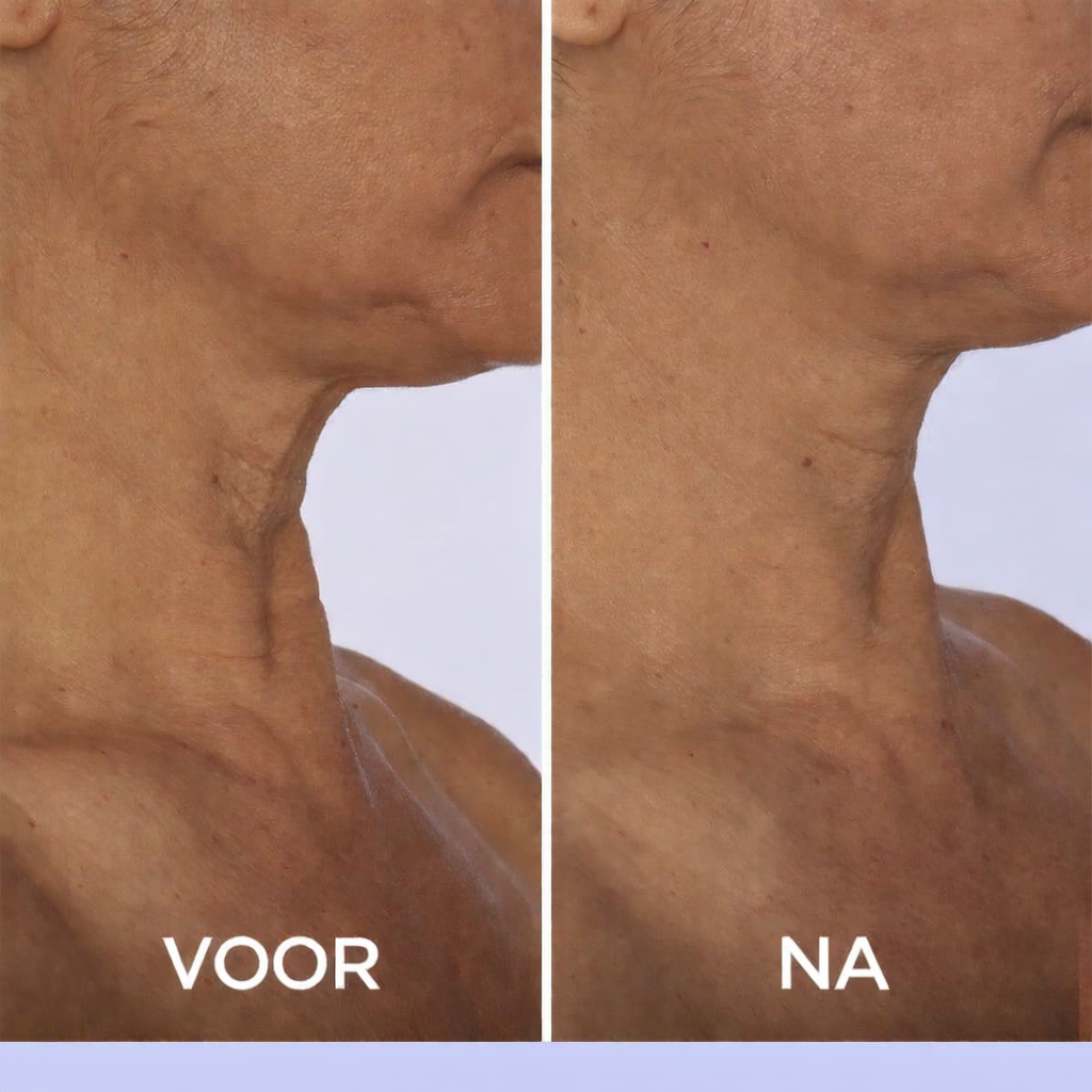 velvetlift-hals-creme voor na 1