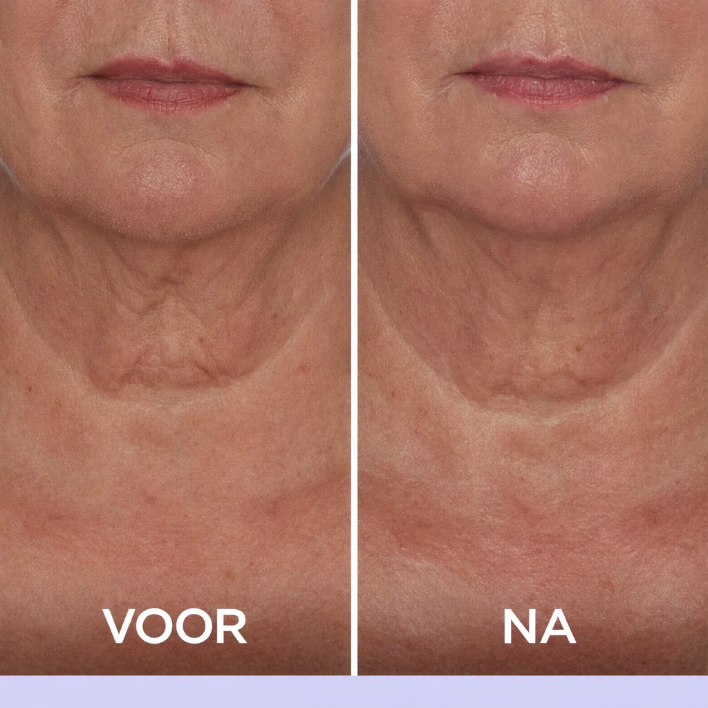 velvetlift-hals-creme voor na 2